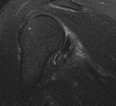Figure 3 for case Reverse bankart and hill sachs lesions